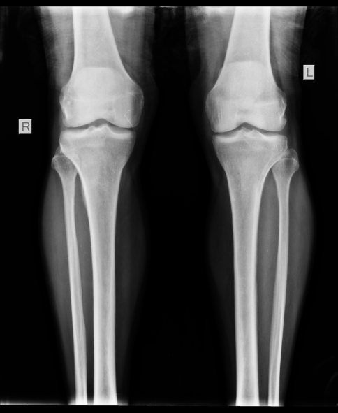 Prevenire l’osteoporosi: una scelta di salute, autonomia e dignità per le persone anziane